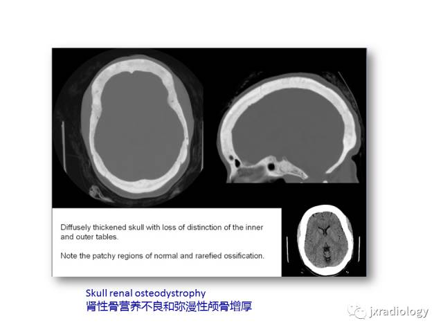 【PPT】颅骨增厚的影像学评价