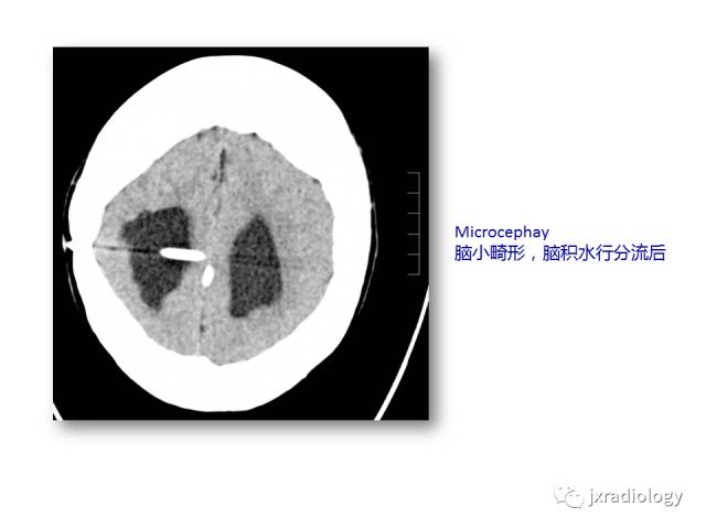 【PPT】颅骨增厚的影像学评价