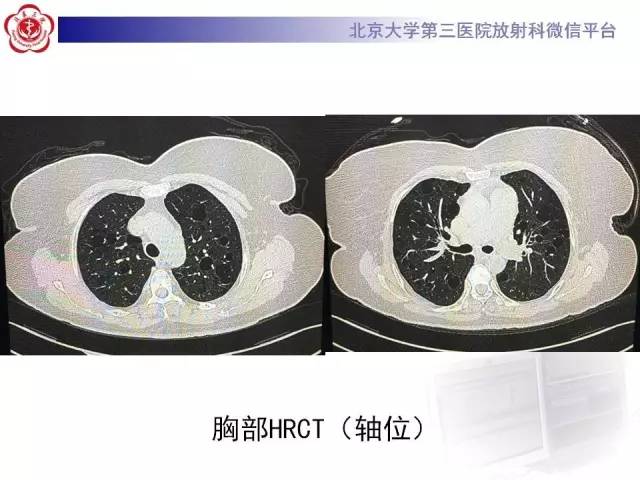 【病例】肺淋巴管肌瘤病1例CT影像表现
