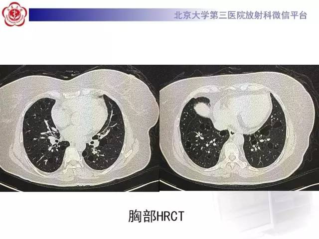 【病例】肺淋巴管肌瘤病1例CT影像表现