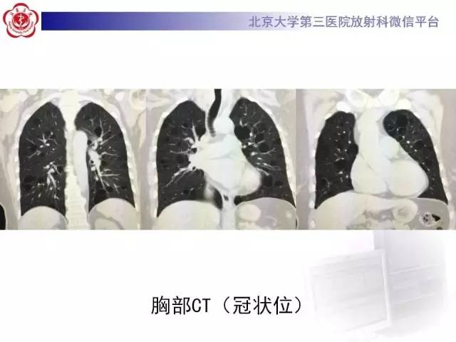 【病例】肺淋巴管肌瘤病1例CT影像表现