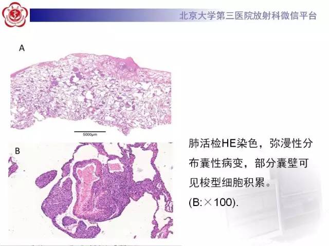 【病例】肺淋巴管肌瘤病1例CT影像表现