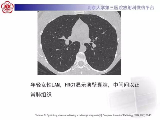 【病例】肺淋巴管肌瘤病1例CT影像表现
