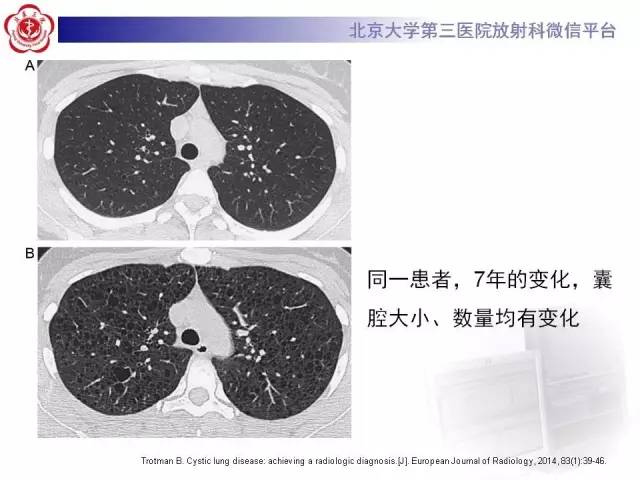 【病例】肺淋巴管肌瘤病1例CT影像表现