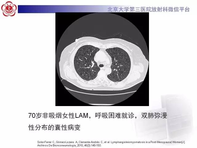 【病例】肺淋巴管肌瘤病1例CT影像表现