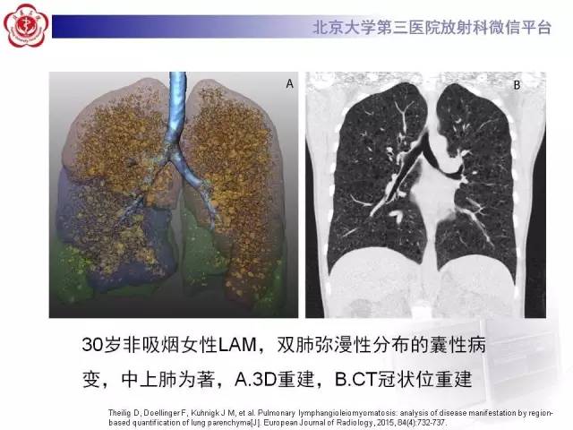 【病例】肺淋巴管肌瘤病1例CT影像表现