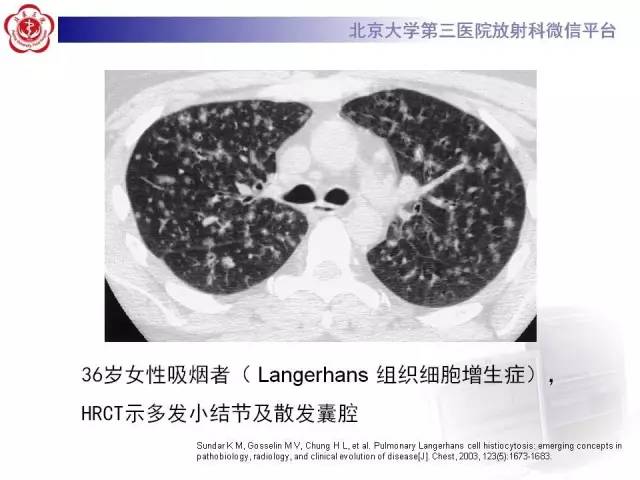 【病例】肺淋巴管肌瘤病1例CT影像表现