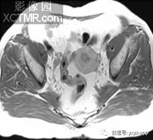【病例】子宫体癌1例MR影像表现 【病例】子宫体癌1例MR影像表现