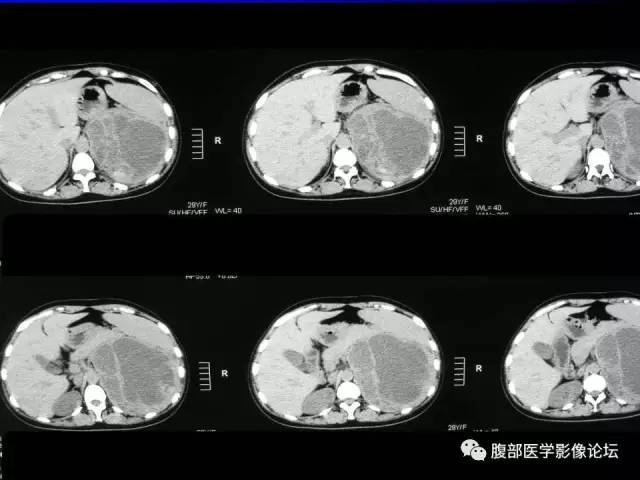 【病例】肾上腺节细胞神经纤维瘤1例CT及MR