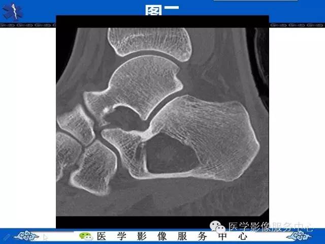 【影像征象】帽徽征——骨脂肪瘤