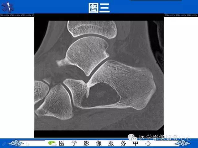 【影像征象】帽徽征——骨脂肪瘤