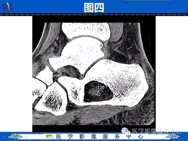【影像征象】帽徽征——骨脂肪瘤