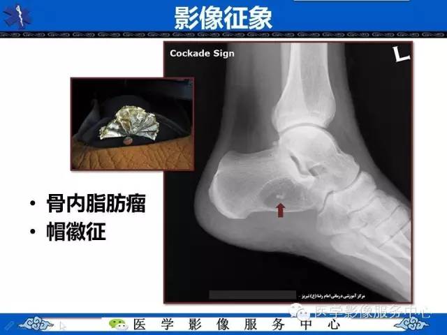 【影像征象】帽徽征——骨脂肪瘤