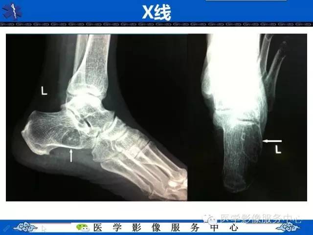 【影像征象】帽徽征——骨脂肪瘤