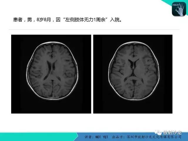 【病例】基底节区生殖细胞瘤1例MR影像表现