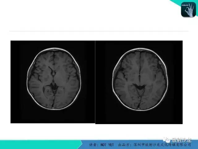 【病例】基底节区生殖细胞瘤1例MR影像表现