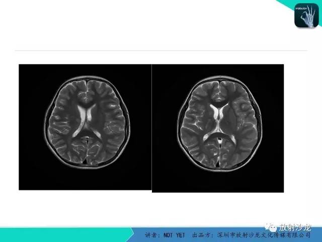 【病例】基底节区生殖细胞瘤1例MR影像表现