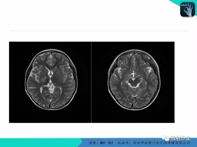 【病例】基底节区生殖细胞瘤1例MR影像表现