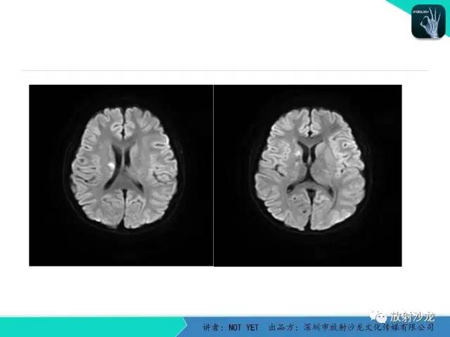 【病例】基底节区生殖细胞瘤1例MR影像表现