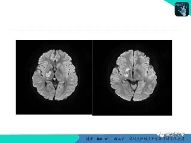 【病例】基底节区生殖细胞瘤1例MR影像表现
