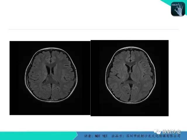 【病例】基底节区生殖细胞瘤1例MR影像表现