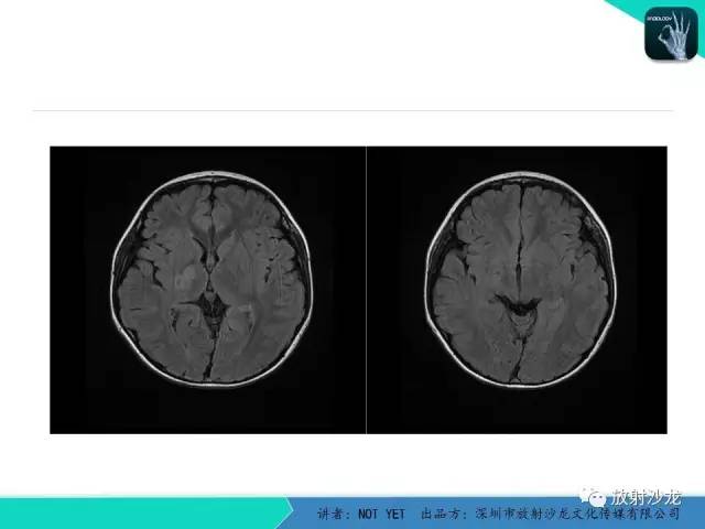 【病例】基底节区生殖细胞瘤1例MR影像表现