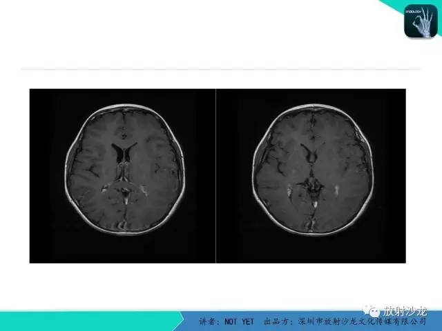 【病例】基底节区生殖细胞瘤1例MR影像表现