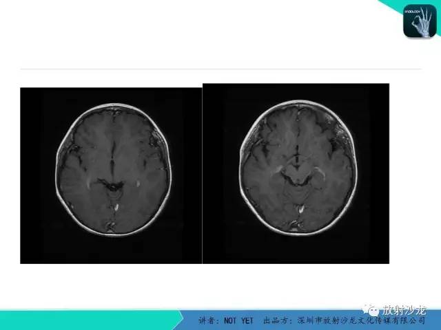 【病例】基底节区生殖细胞瘤1例MR影像表现