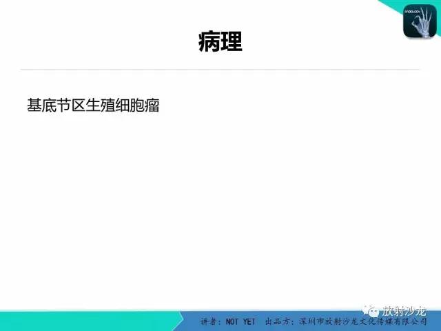 【病例】基底节区生殖细胞瘤1例MR影像表现
