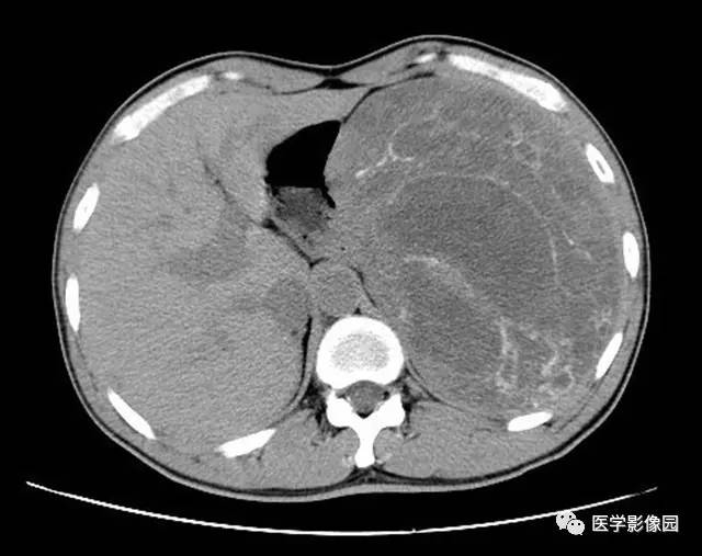 【病例】脾脏陈旧性出血伴玻璃样变性及纤维素样坏死1例CT 【病例】脾脏陈旧性出血伴玻璃样变性及纤维素样坏死1例CT