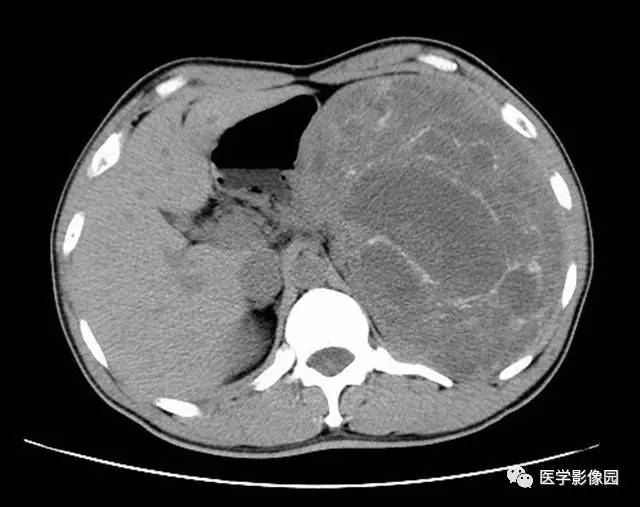 【病例】脾脏陈旧性出血伴玻璃样变性及纤维素样坏死1例CT 【病例】脾脏陈旧性出血伴玻璃样变性及纤维素样坏死1例CT