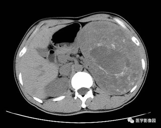 【病例】脾脏陈旧性出血伴玻璃样变性及纤维素样坏死1例CT 【病例】脾脏陈旧性出血伴玻璃样变性及纤维素样坏死1例CT