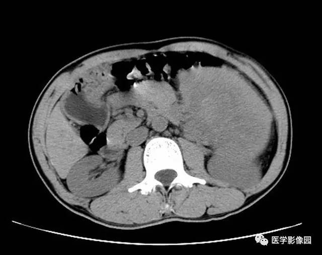 【病例】脾脏陈旧性出血伴玻璃样变性及纤维素样坏死1例CT 【病例】脾脏陈旧性出血伴玻璃样变性及纤维素样坏死1例CT