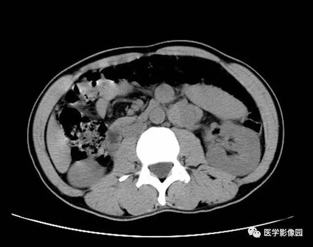 【病例】脾脏陈旧性出血伴玻璃样变性及纤维素样坏死1例CT 【病例】脾脏陈旧性出血伴玻璃样变性及纤维素样坏死1例CT