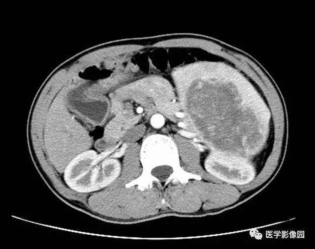 【病例】脾脏陈旧性出血伴玻璃样变性及纤维素样坏死1例CT 【病例】脾脏陈旧性出血伴玻璃样变性及纤维素样坏死1例CT