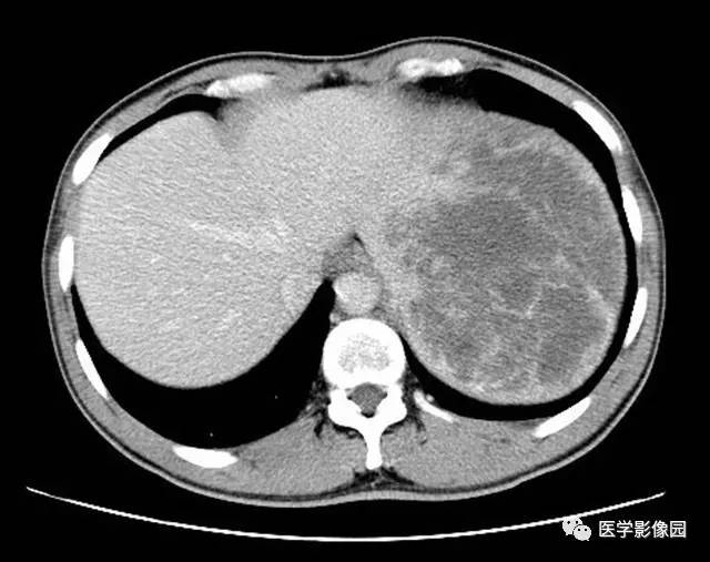 【病例】脾脏陈旧性出血伴玻璃样变性及纤维素样坏死1例CT 【病例】脾脏陈旧性出血伴玻璃样变性及纤维素样坏死1例CT