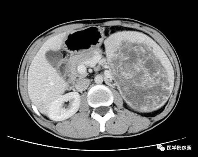 【病例】脾脏陈旧性出血伴玻璃样变性及纤维素样坏死1例CT 【病例】脾脏陈旧性出血伴玻璃样变性及纤维素样坏死1例CT