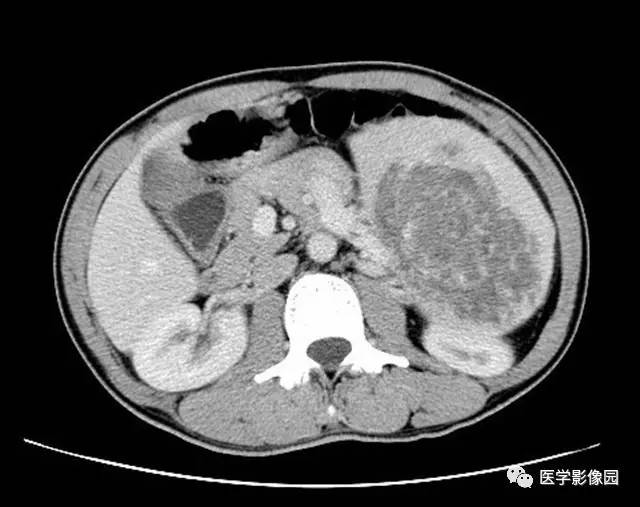 【病例】脾脏陈旧性出血伴玻璃样变性及纤维素样坏死1例CT 【病例】脾脏陈旧性出血伴玻璃样变性及纤维素样坏死1例CT