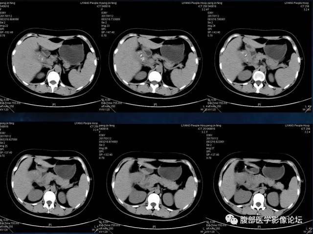 【病例】胆囊癌侵犯结肠肝曲1例CT 【病例】胆囊癌侵犯结肠肝曲1例CT