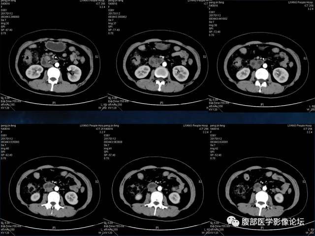 【病例】胆囊癌侵犯结肠肝曲1例CT 【病例】胆囊癌侵犯结肠肝曲1例CT
