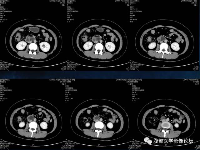 【病例】胆囊癌侵犯结肠肝曲1例CT 【病例】胆囊癌侵犯结肠肝曲1例CT
