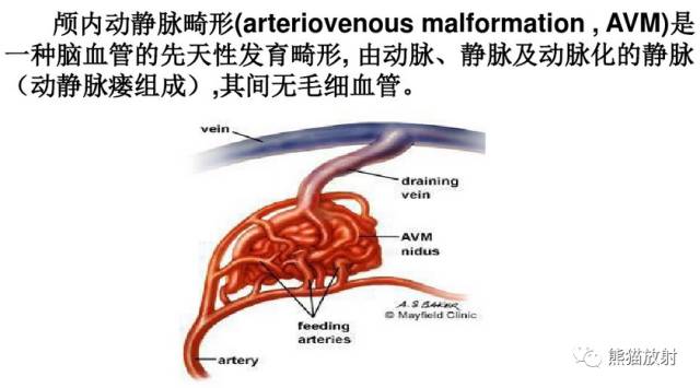 【影像病理】颅内动静脉畸形、动脉瘤、海绵状血管瘤 【影像病理】颅内动静脉畸形、动脉瘤、海绵状血管瘤