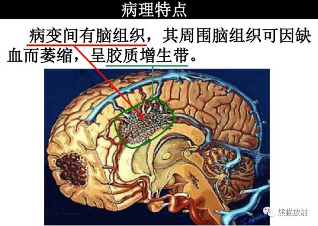 【影像病理】颅内动静脉畸形、动脉瘤、海绵状血管瘤 【影像病理】颅内动静脉畸形、动脉瘤、海绵状血管瘤