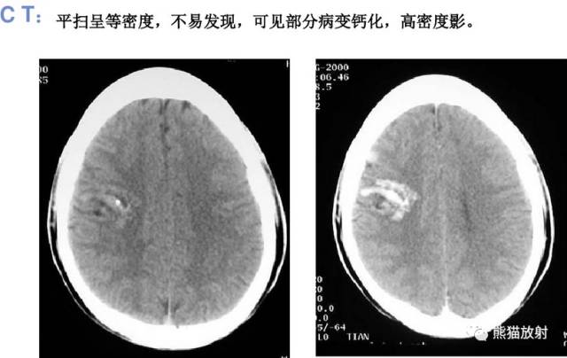 【影像病理】颅内动静脉畸形、动脉瘤、海绵状血管瘤 【影像病理】颅内动静脉畸形、动脉瘤、海绵状血管瘤