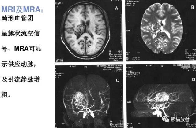 【影像病理】颅内动静脉畸形、动脉瘤、海绵状血管瘤 【影像病理】颅内动静脉畸形、动脉瘤、海绵状血管瘤