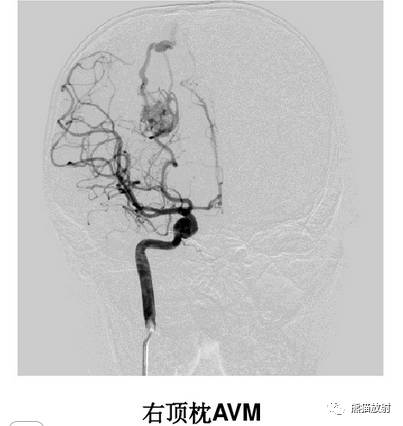 【影像病理】颅内动静脉畸形、动脉瘤、海绵状血管瘤 【影像病理】颅内动静脉畸形、动脉瘤、海绵状血管瘤
