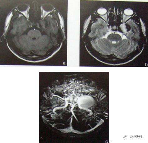 【影像病理】颅内动静脉畸形、动脉瘤、海绵状血管瘤 【影像病理】颅内动静脉畸形、动脉瘤、海绵状血管瘤