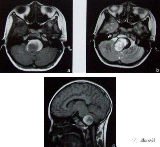 【影像病理】颅内动静脉畸形、动脉瘤、海绵状血管瘤 【影像病理】颅内动静脉畸形、动脉瘤、海绵状血管瘤