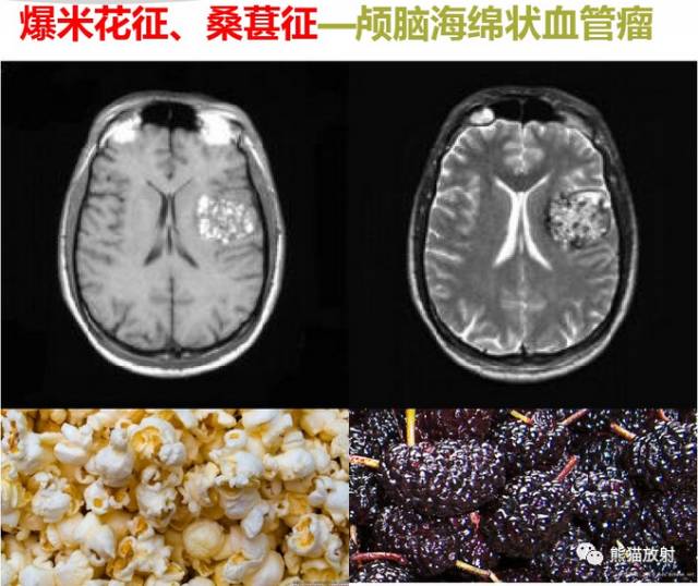【影像病理】颅内动静脉畸形、动脉瘤、海绵状血管瘤 【影像病理】颅内动静脉畸形、动脉瘤、海绵状血管瘤