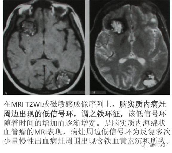 【影像病理】颅内动静脉畸形、动脉瘤、海绵状血管瘤 【影像病理】颅内动静脉畸形、动脉瘤、海绵状血管瘤